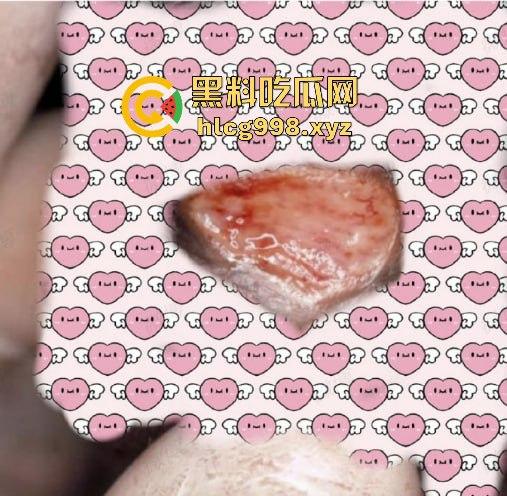 梅毒像疯狗一样乱咬!日本疫情横扫全球,日本卫生部出狠招断根大法安排上,管不住下半身只能禁爱?-4