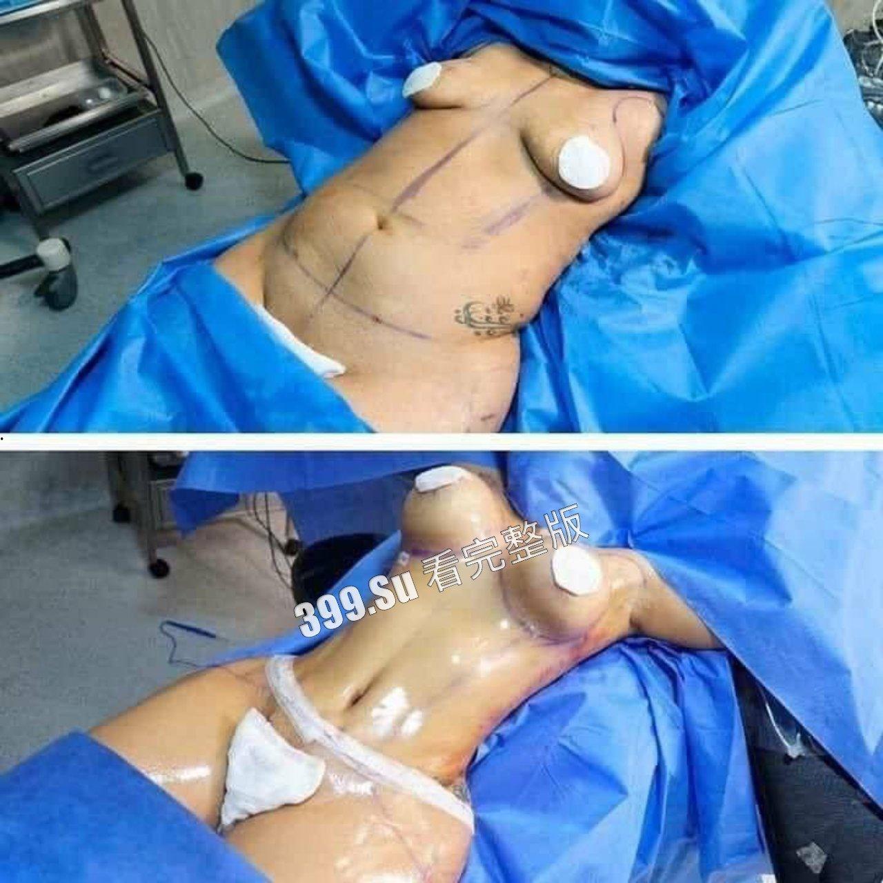 医美整形那些事儿 假的真不了 女人对自己真狠 阴唇黑了就直接切掉 (二)-1