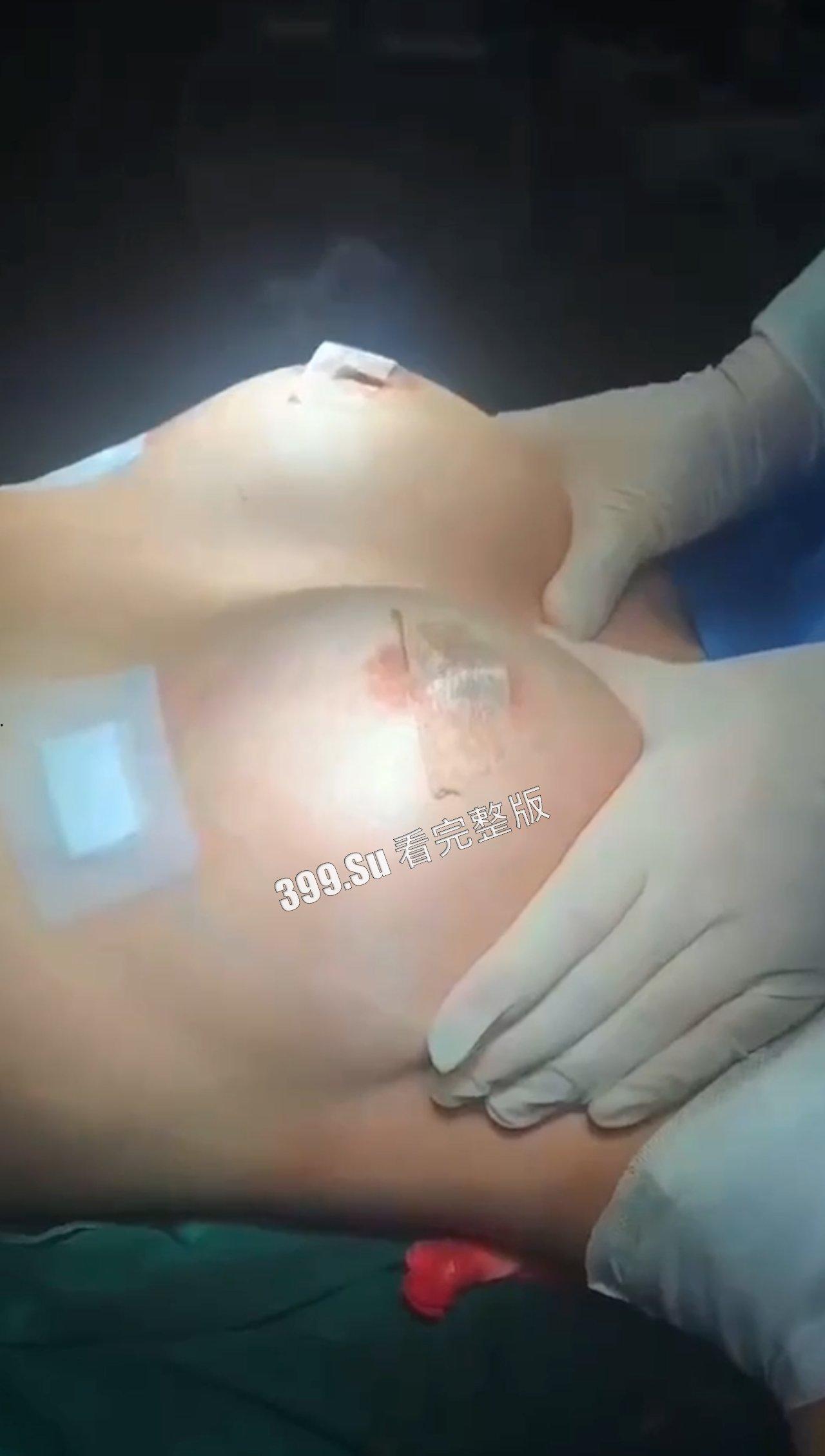 医美整形那些事儿 假的真不了 女人对自己真狠 阴唇黑了就直接切掉 (二)-6