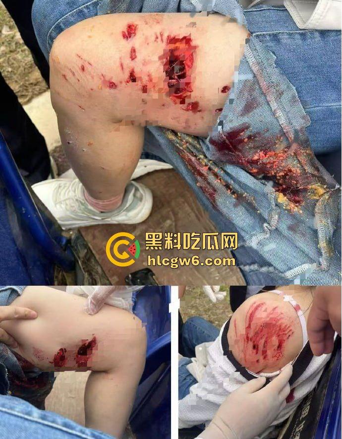 江西赣州母女在公园散步被四条野狗攻击撕咬,扯下来的肉被吃掉,暴露性伤口可以塞进一只手-3