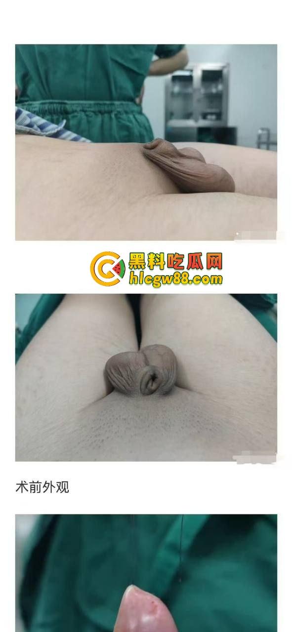 小鸟变大雕换炮计划!阴茎增大手术震撼实测 9CM秒变18CM战神之枪 ,这根真的压不住了!-1