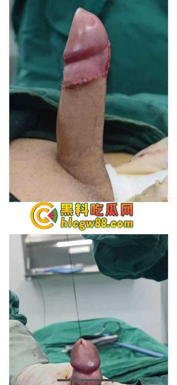 小鸟变大雕换炮计划!阴茎增大手术震撼实测 9CM秒变18CM战神之枪 ,这根真的压不住了!-2