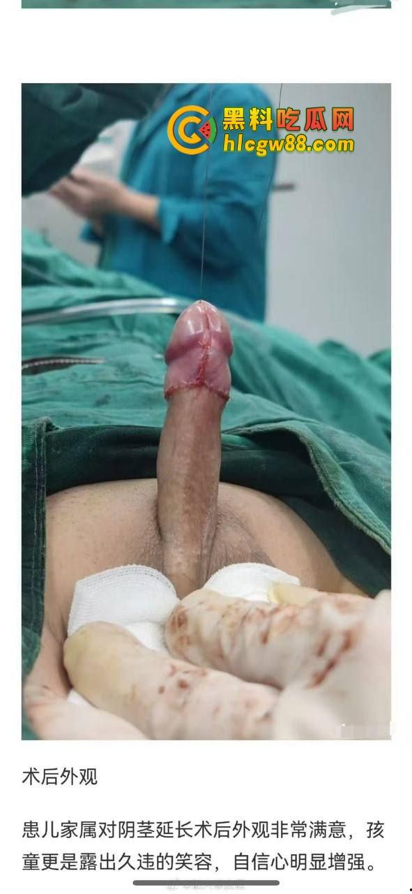 小鸟变大雕换炮计划!阴茎增大手术震撼实测 9CM秒变18CM战神之枪 ,这根真的压不住了!-3