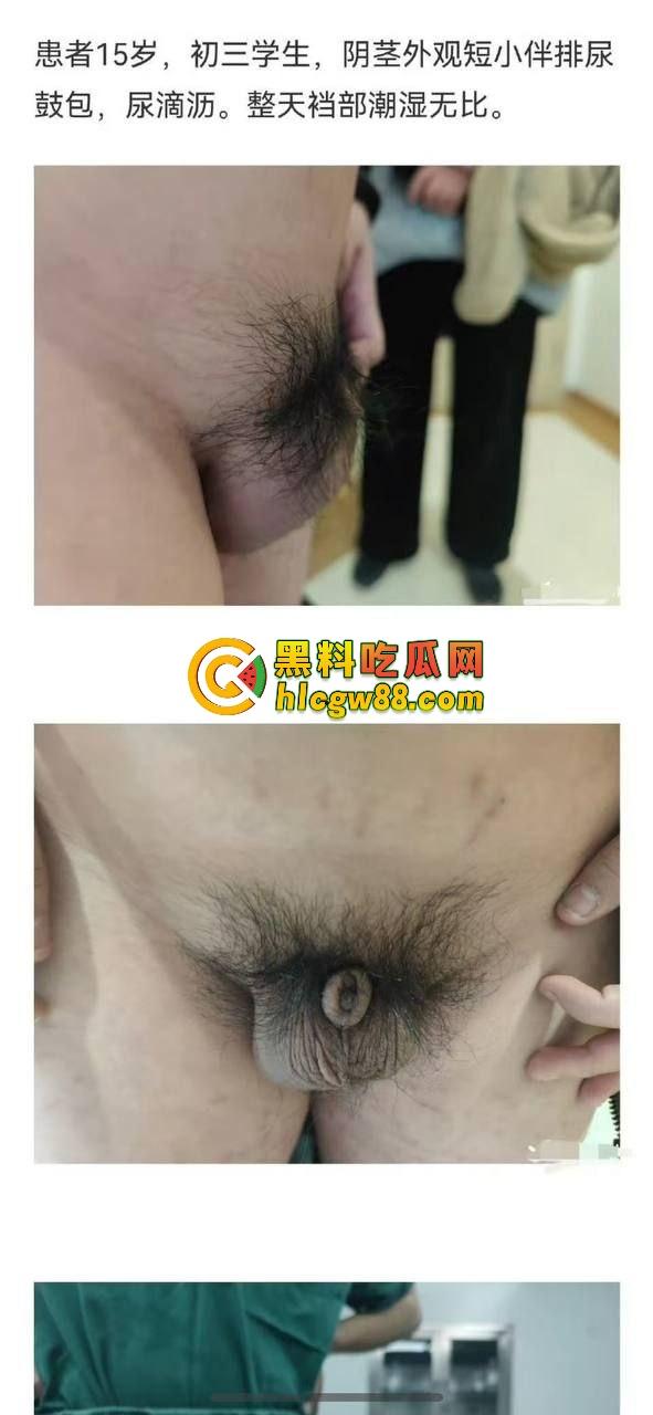 小鸟变大雕换炮计划!阴茎增大手术震撼实测 9CM秒变18CM战神之枪 ,这根真的压不住了!-4