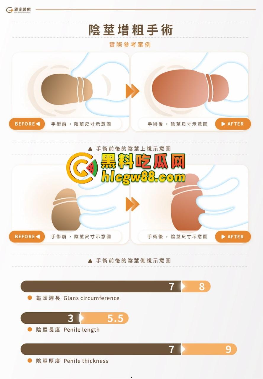 小鸟变大雕换炮计划!阴茎增大手术震撼实测 9CM秒变18CM战神之枪 ,这根真的压不住了!-5