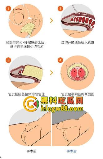 小鸟变大雕换炮计划!阴茎增大手术震撼实测 9CM秒变18CM战神之枪 ,这根真的压不住了!-6