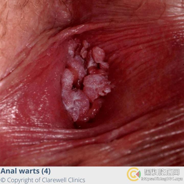 性病篇  谨慎观看！瓜友们出门在外 一定得洁身自爱 世界上没有后悔药  安全第一！！！ （二）-5