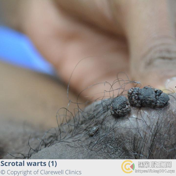 性病篇  谨慎观看！瓜友们出门在外 一定得洁身自爱 世界上没有后悔药  安全第一！！！ （二）-16