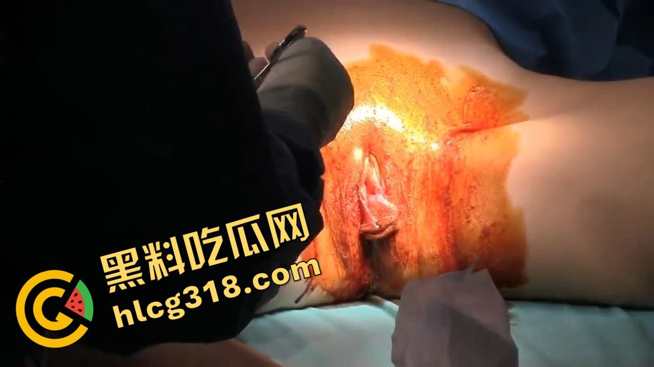 阴唇整形一刀逆天改命,黑木耳变粉鲍鱼,大阴唇手术直接打造一线天馒头逼,姑娘做完直接彩礼翻倍!-6