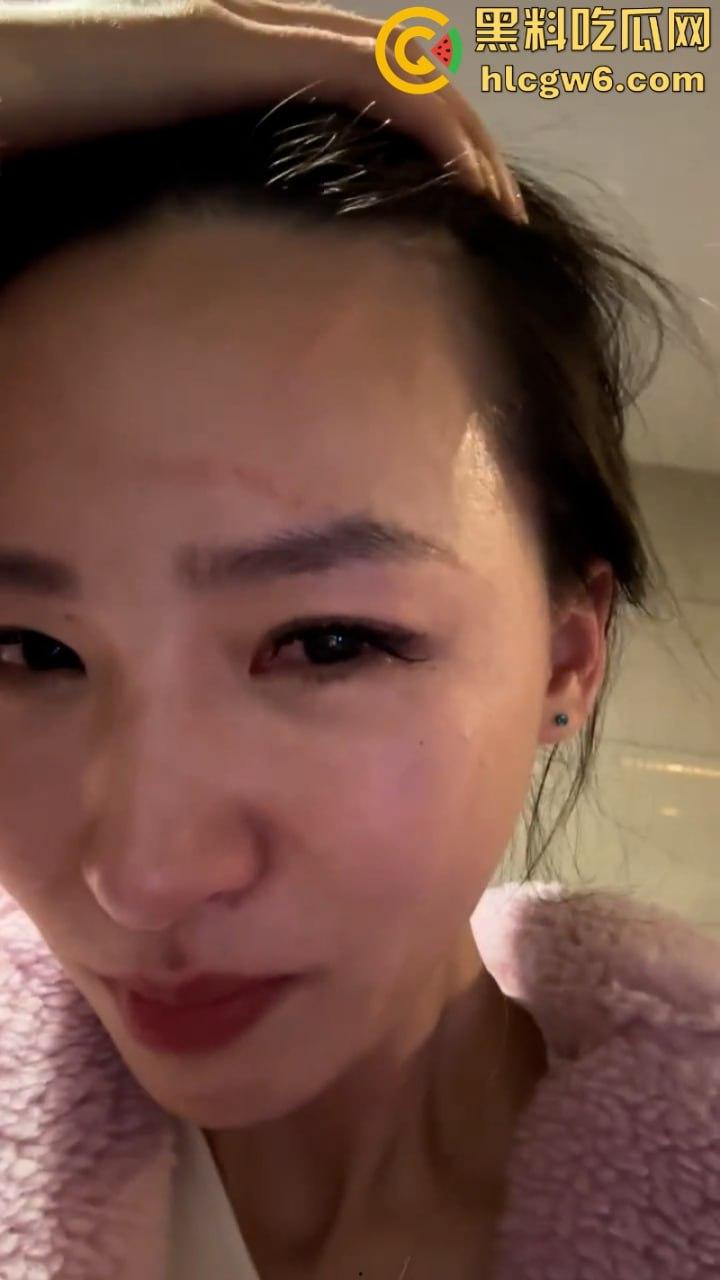 湖北一小学美女老师抖音自曝离婚探女遭前夫爹殴打抓脸全身多处受伤 伤情实拍曝光！都是血口子-8