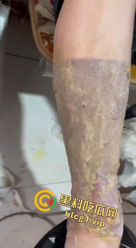 内蒙古呼和浩特惊魂一刻!02年精神小伙偷骑V4机车撞上右转SUV,摩托车当场燃烧!-11