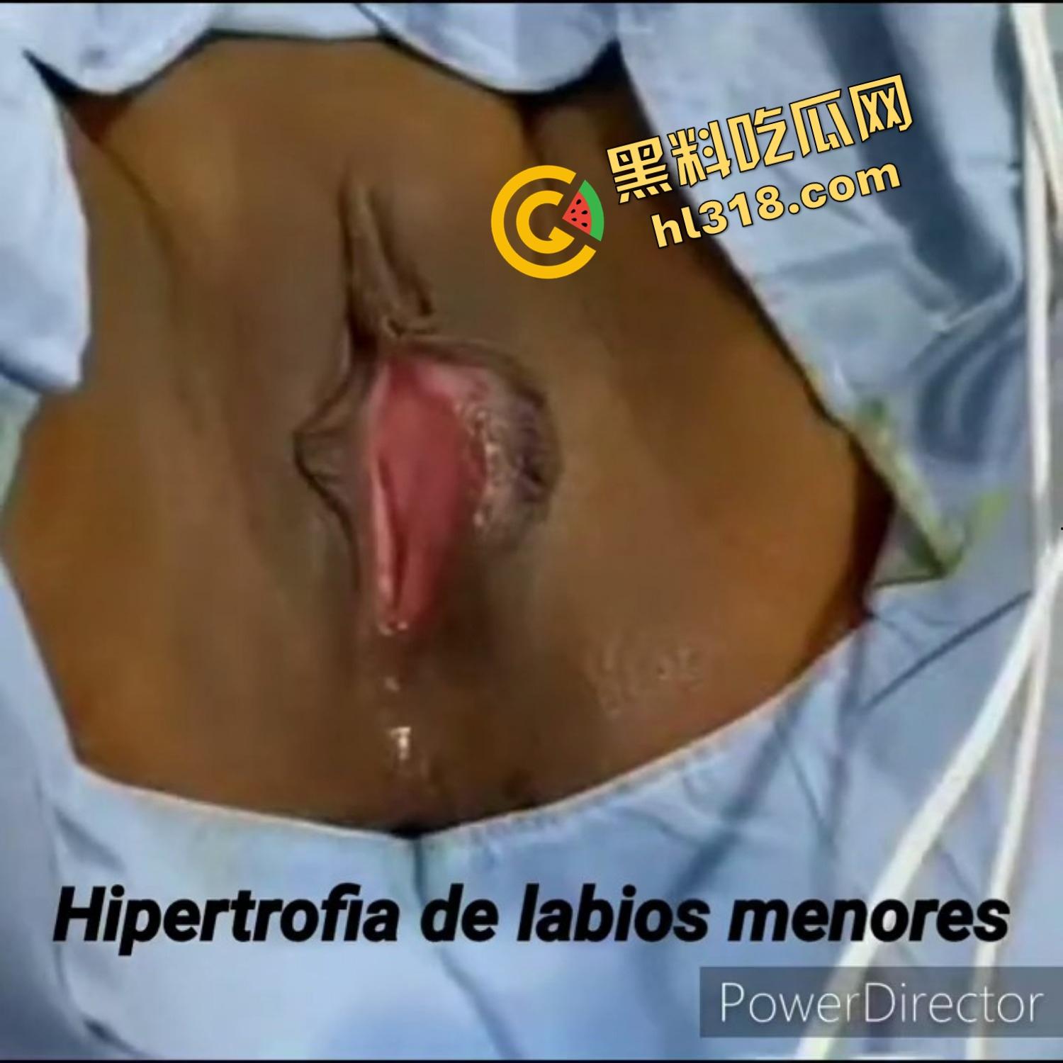 人工白虎一线天馒头逼逆天改命全流程，激光割黑阴唇，手术后完美蜕变，这才是新时代白虎一线天！-6