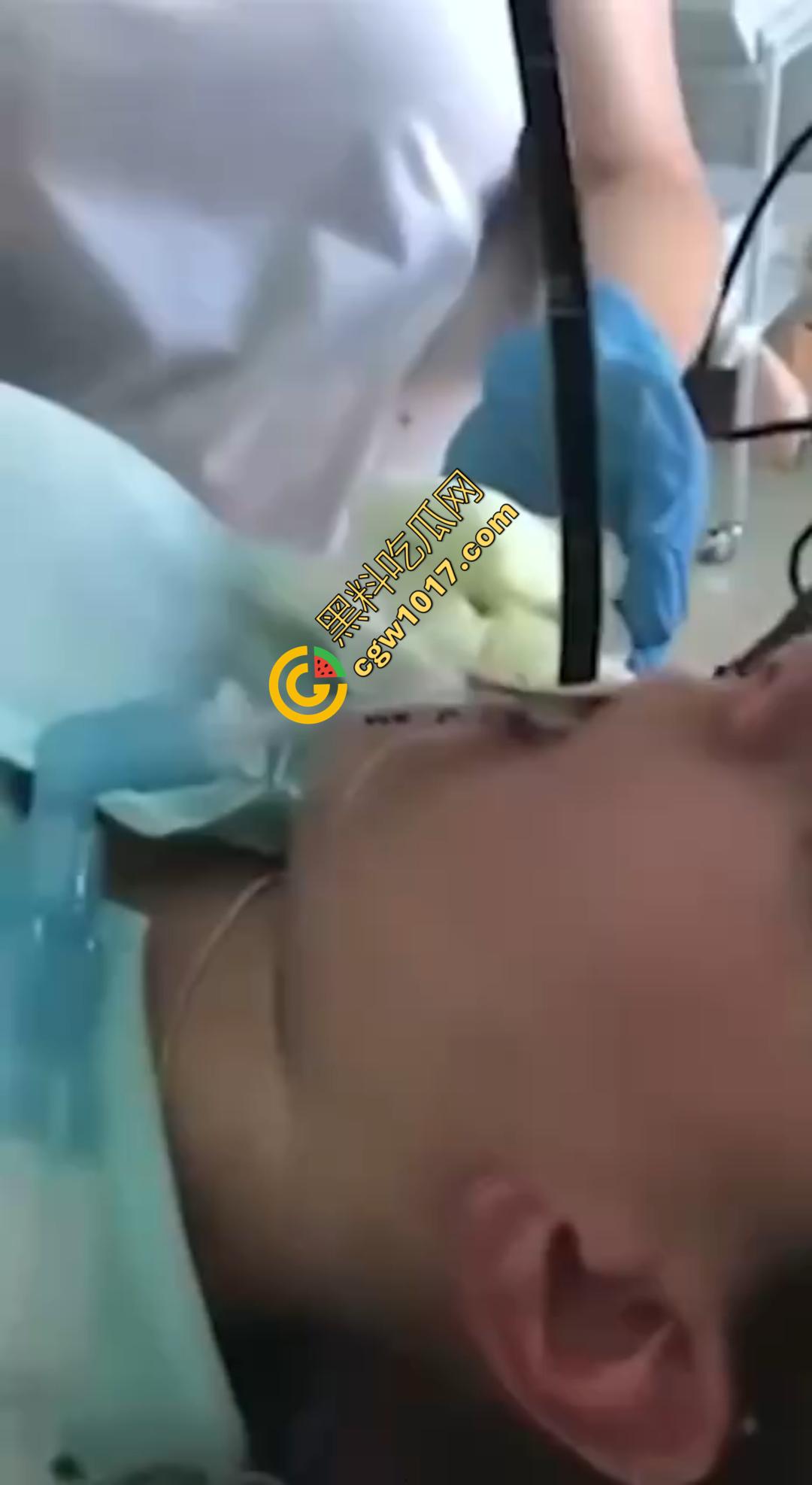 俄罗斯医院活拽1米毒蛇!女患者吞蛇卵孵化钻喉,医生手抖拽出瞬间到处乱窜!-1