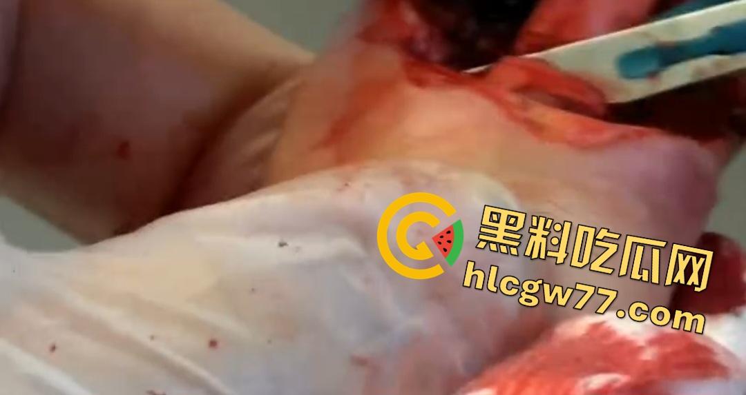 患者天天啃脚指甲狂得甲沟炎!帕尔米耶里手术刀下血肉狂飙,操刀医生差点呕吐!-1