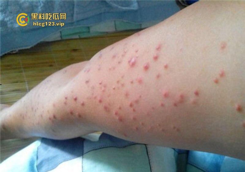 可怕!为了报复社会把带血针头扎进了共享单车的座椅里……山东商业技师学校20个被感染艾滋!!!-7