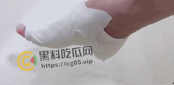 新时代裹脚女性!00后女生爱上裹脚 推特分享裹脚经历 把脚缠到骨折变形 吓人!-10