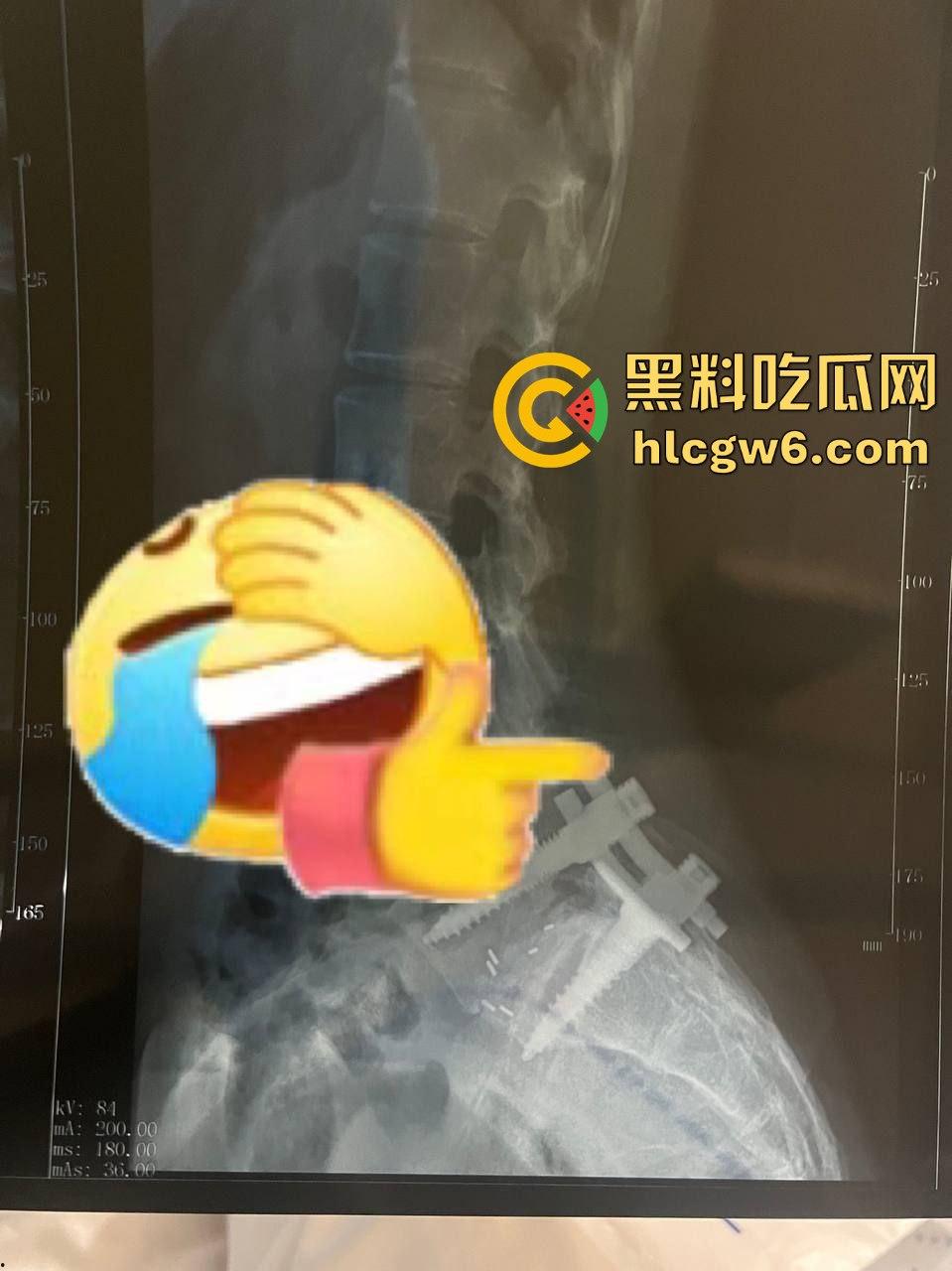 厦门大学嘉庚学院爆发校园霸凌事件！大四学姐被殴打险瘫痪，学校深夜删帖惹怒学生，游行群组已悄然建立！-6