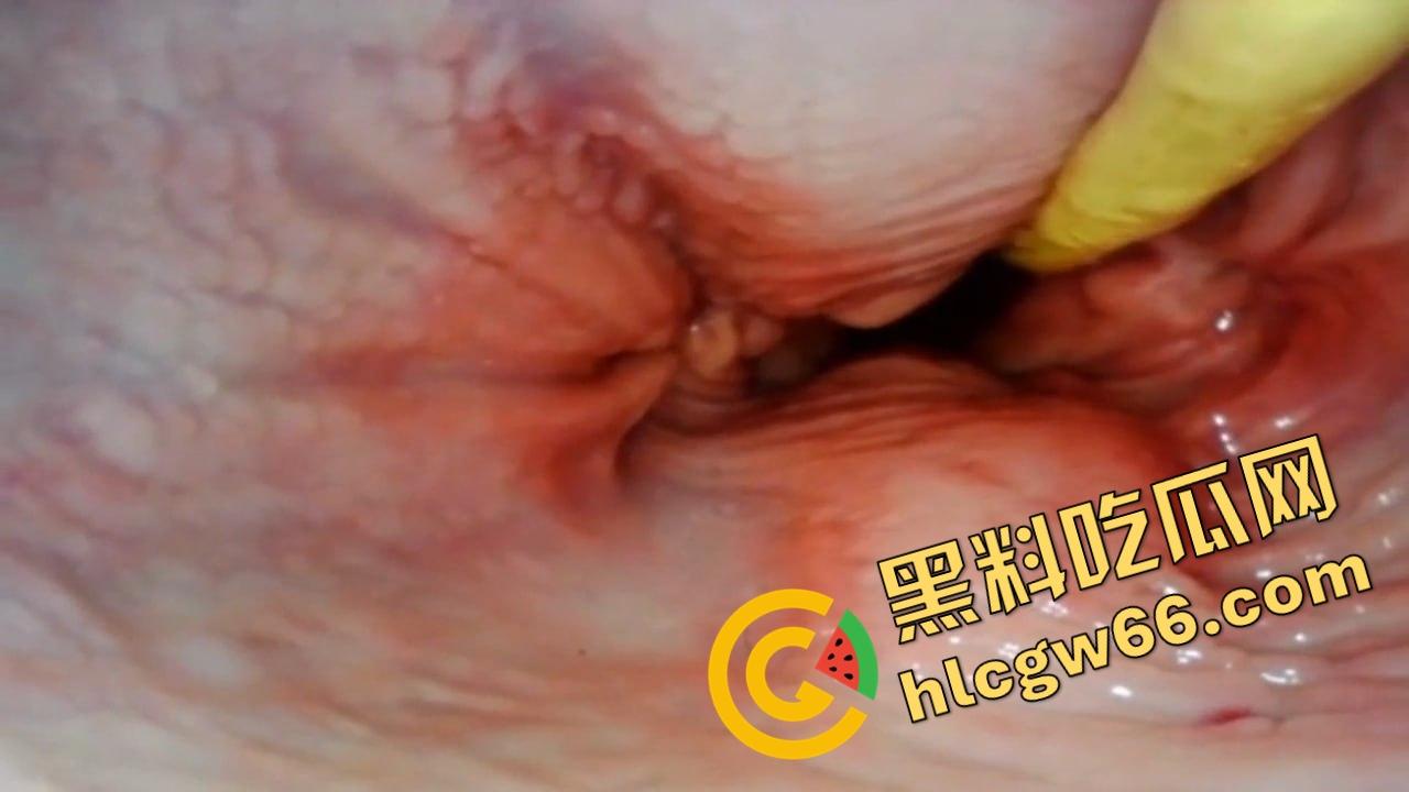 欧美巨屌狂插内窥视角爆火阴道深处褶皱翻卷、肉壁收缩蠕动,全程高清记录快感源头!-11