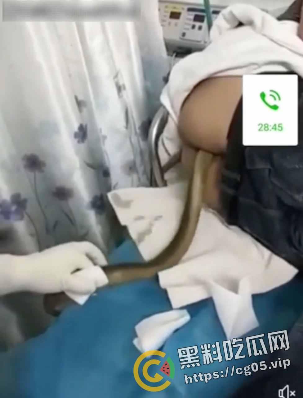 黄鳝入肛 一去不回 整活把自己整进医院了 医生扯出来半米长的黄鳝惊呆了-3