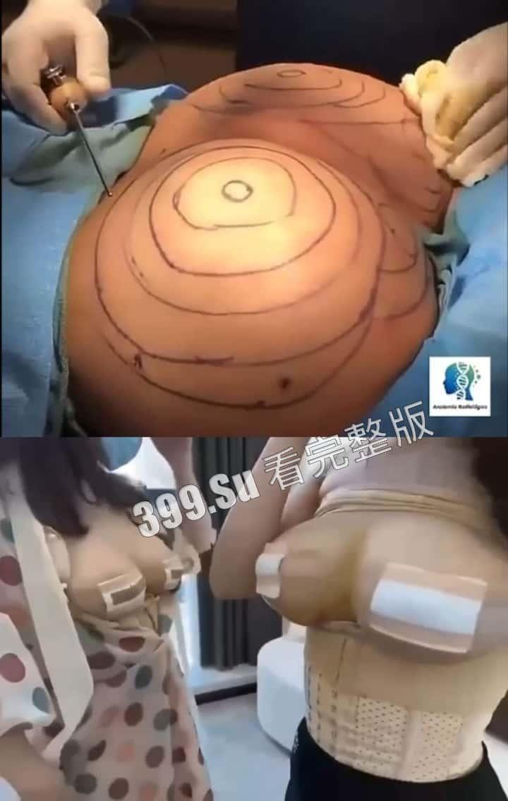 医美整形那些事儿 假的真不了 看的脸皮发麻 (三)-5