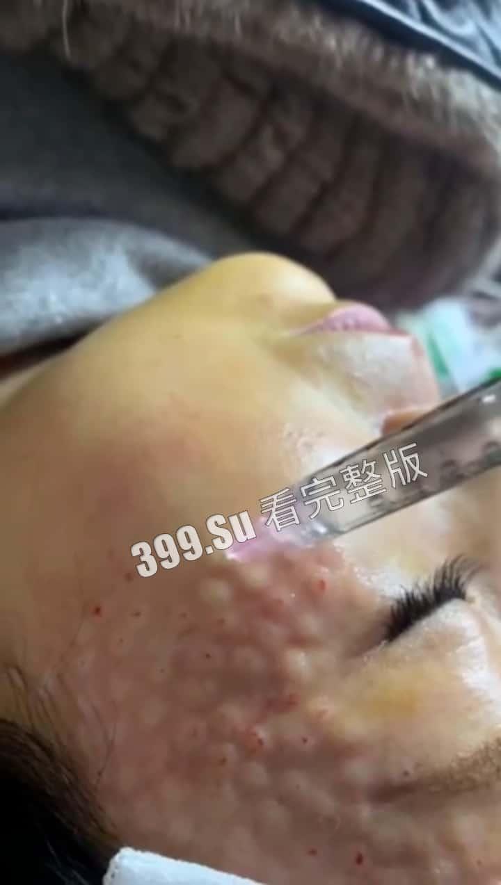 医美整形那些事儿 假的真不了 看的脸皮发麻 (三)-8