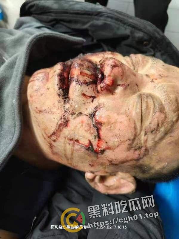 北京马坊镇放火杀人案 犯人【刘峰强】被抓 受害人全身烧烂 手臂被砍 全家老小失去人形 惨不忍睹 血腥慎点-17