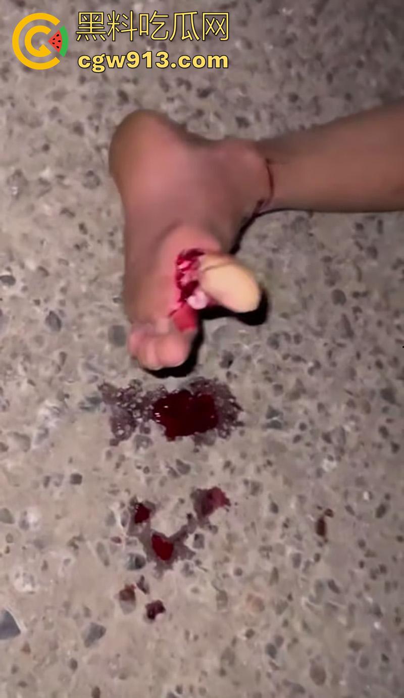 小伙骑摩托车夜晚狂飙，车辆失控撞上对面来车，女友当场飞出死亡，小伙自己全身骨折，看着都疼！-3