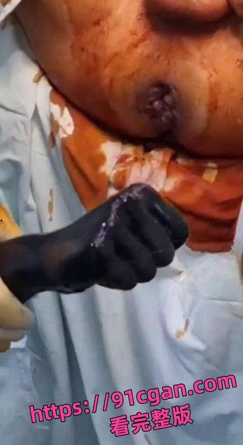 猎奇！拳头形状大玩具从屁股里拔出来的时候医生都憋不住笑了！-3