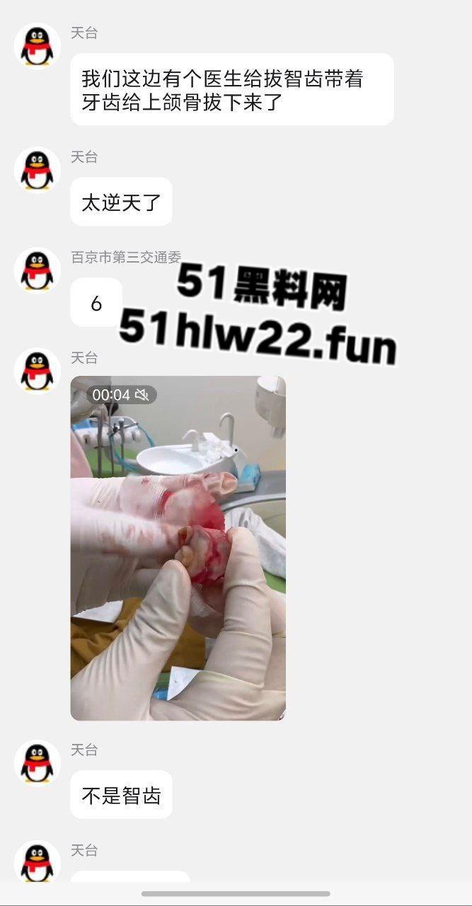 口腔医院逆天操作，客人拔智齿结果医生不分青红皂白直接大力出奇迹， 把上颌骨拔断撤了下来！-4